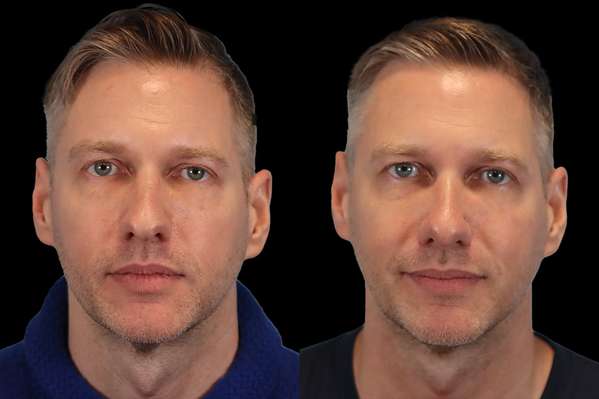 Nose Before and After | Leong Facial Plastic Surgery