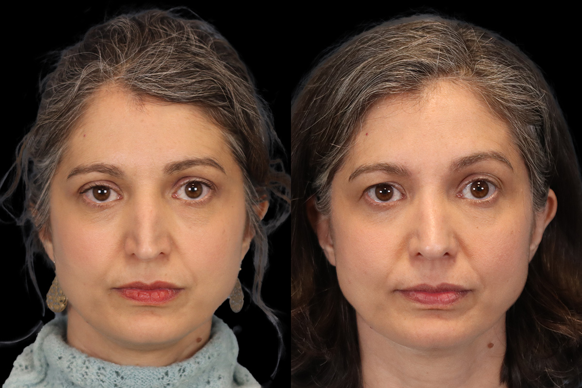 Nose Before and After | Leong Facial Plastic Surgery