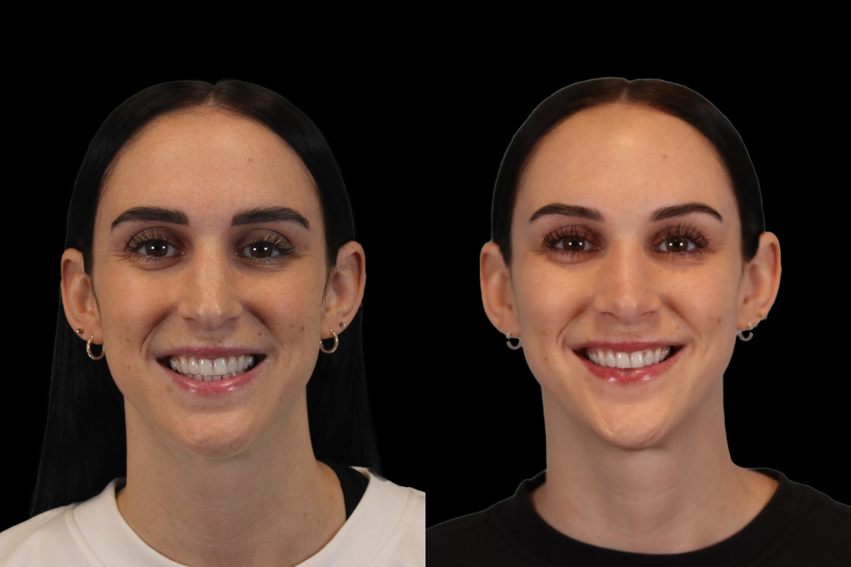 Nose Before and After | Leong Facial Plastic Surgery