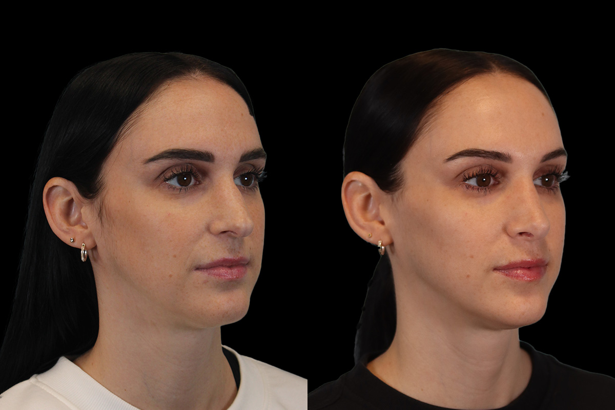 Nose Before and After | Leong Facial Plastic Surgery