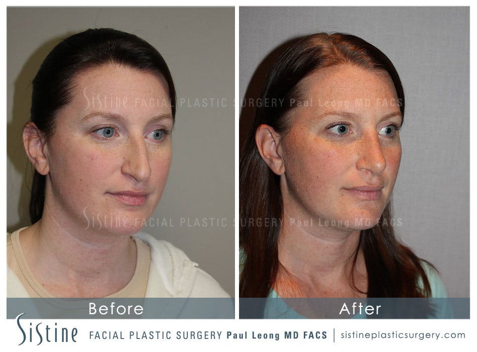 Nose Before and After | Leong Facial Plastic Surgery