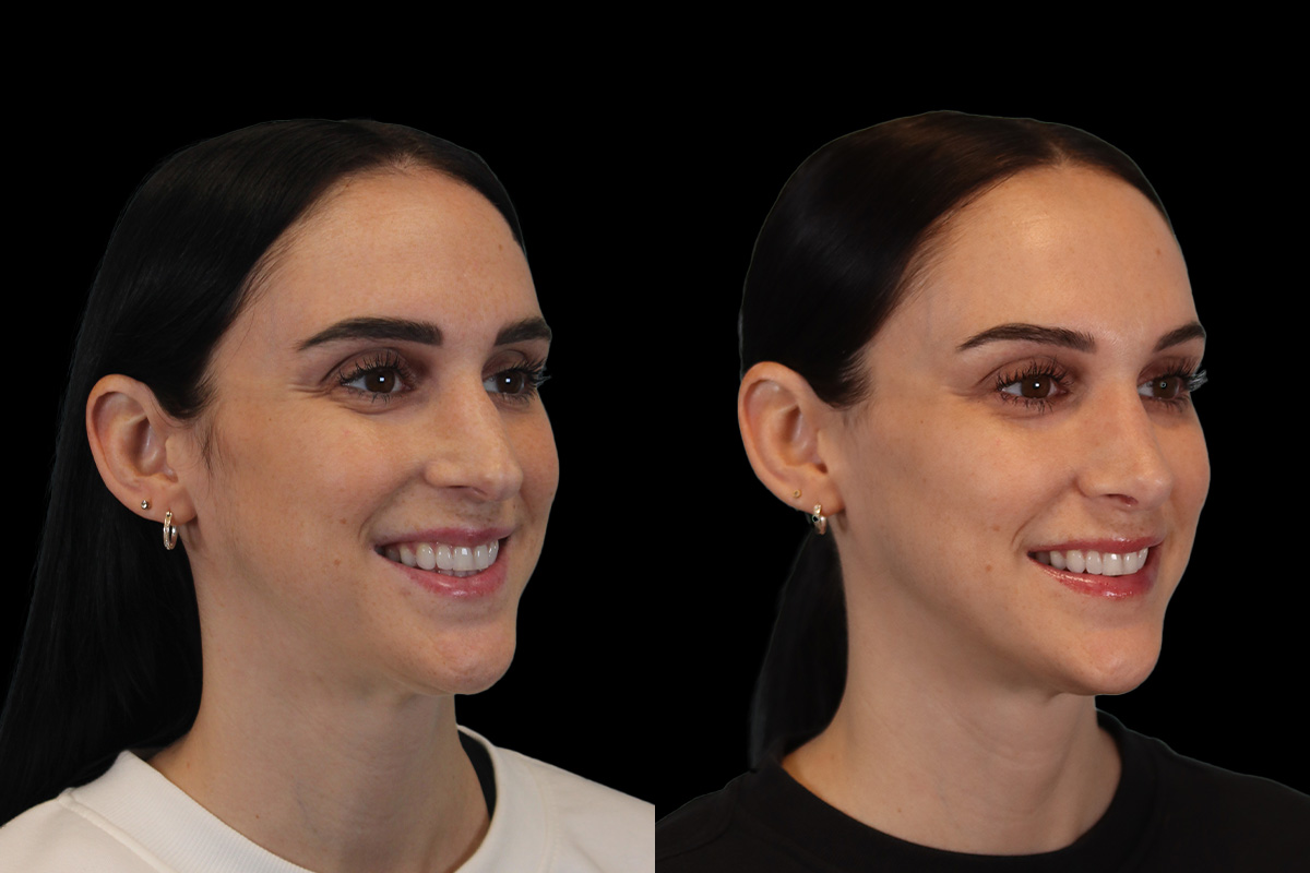 Nose Before and After | Leong Facial Plastic Surgery