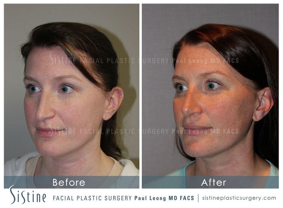 Nose Before and After | Leong Facial Plastic Surgery