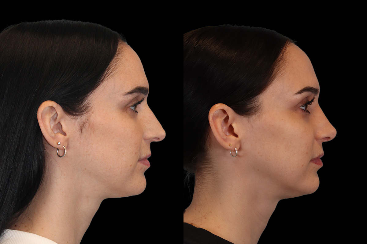 Nose Before and After | Leong Facial Plastic Surgery