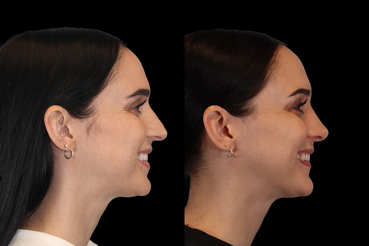 Nose Before and After | Leong Facial Plastic Surgery