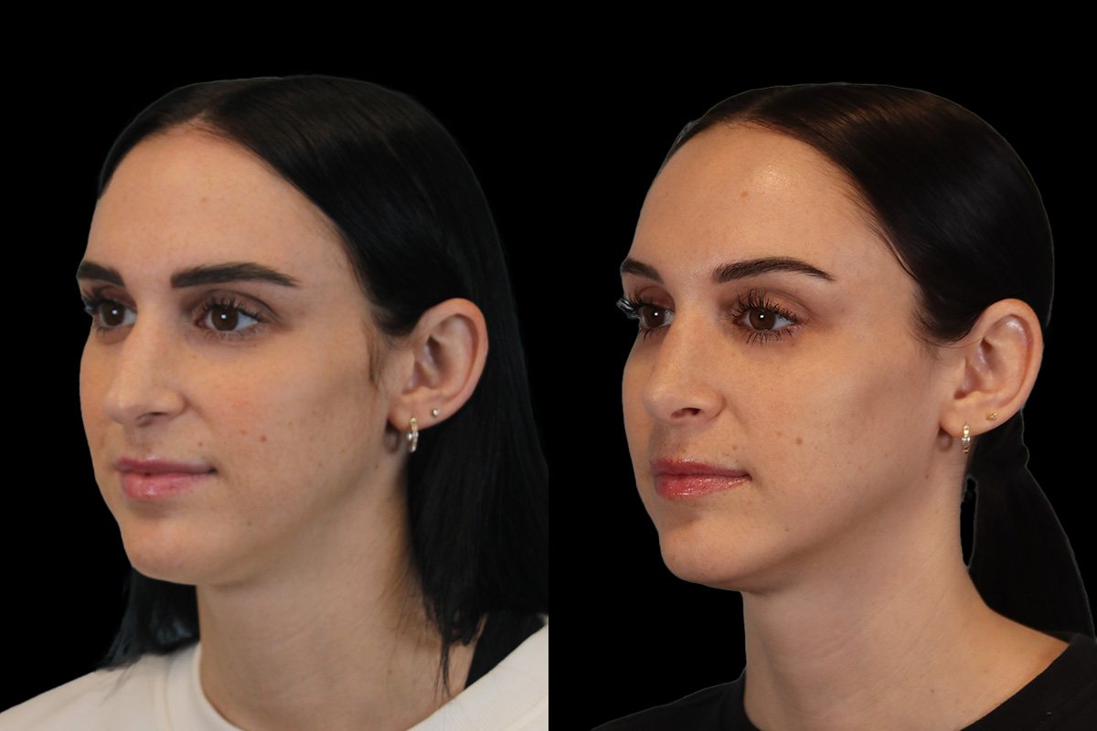 Nose Before and After | Leong Facial Plastic Surgery
