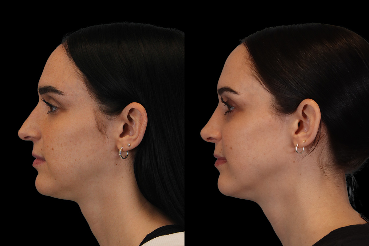 Nose Before and After | Leong Facial Plastic Surgery
