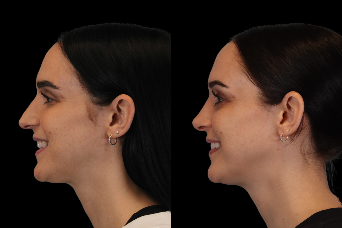 Nose Before and After | Leong Facial Plastic Surgery