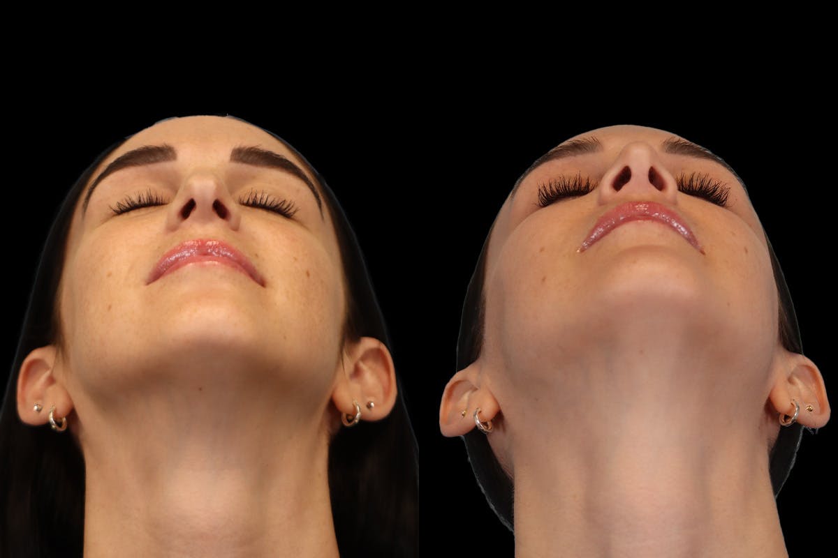Nose Before and After | Leong Facial Plastic Surgery