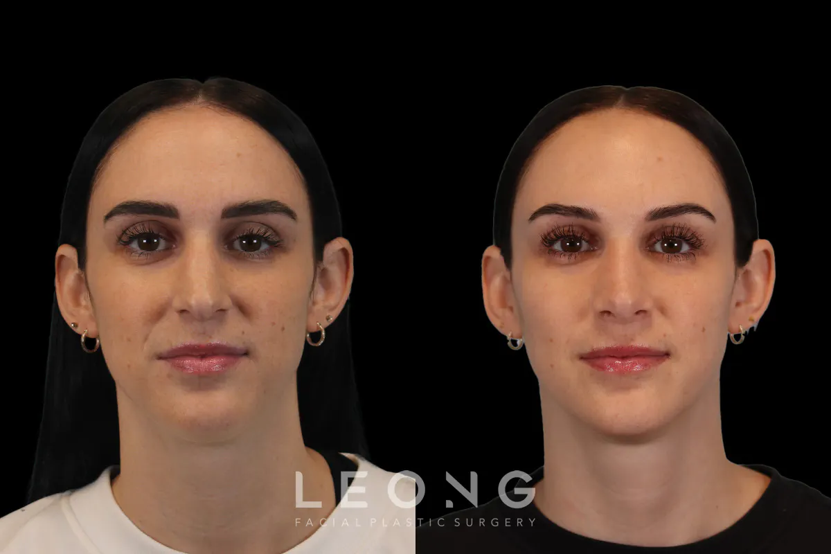 Nose Before and After | Leong Facial Plastic Surgery