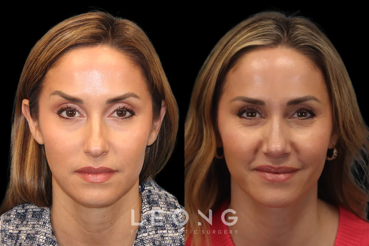 Nose Before and After | Leong Facial Plastic Surgery