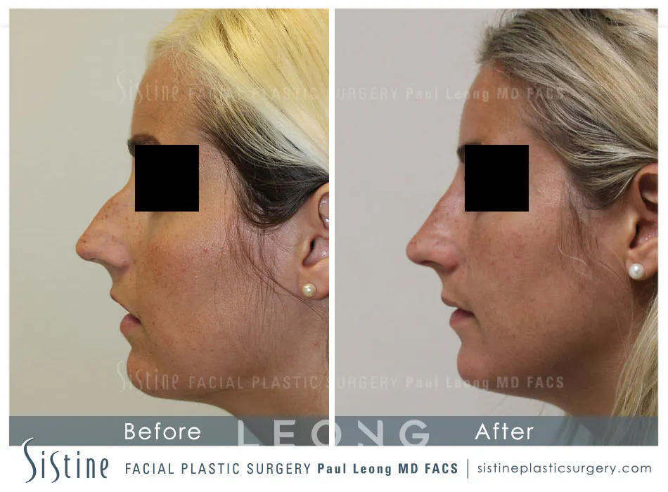 Nose Before and After | Leong Facial Plastic Surgery