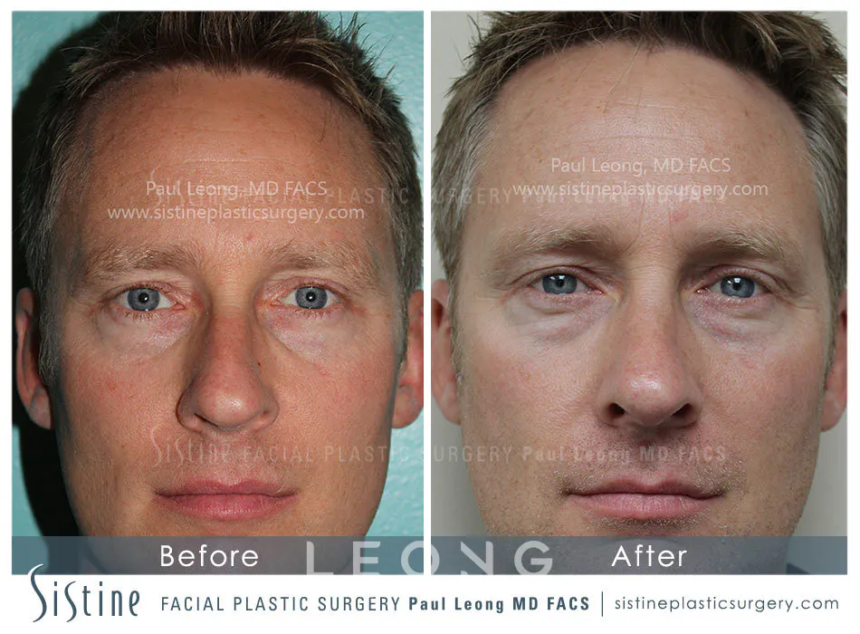 Nose Before and After | Leong Facial Plastic Surgery