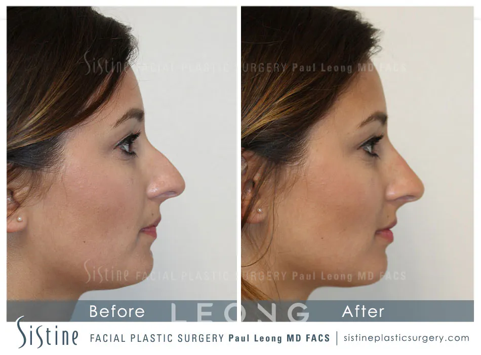 Nose Before and After | Leong Facial Plastic Surgery