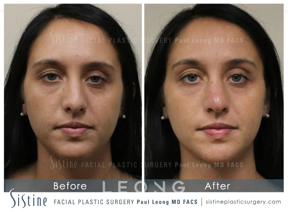 Nose Before and After | Leong Facial Plastic Surgery