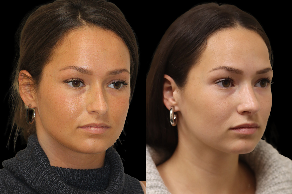 Nose Before and After | Leong Facial Plastic Surgery