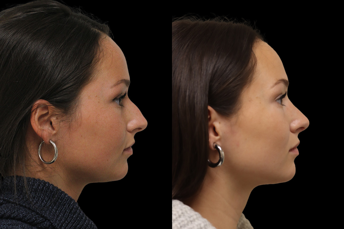 Nose Before and After | Leong Facial Plastic Surgery
