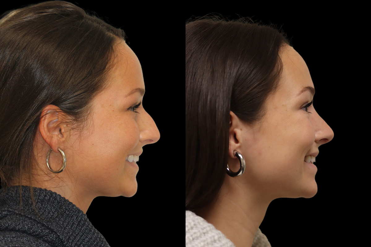 Nose Before and After | Leong Facial Plastic Surgery