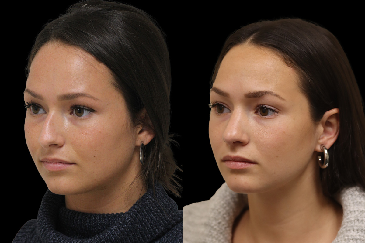 Nose Before and After | Leong Facial Plastic Surgery