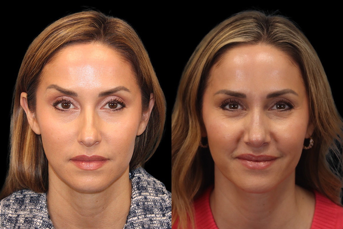Nose Before and After | Leong Facial Plastic Surgery