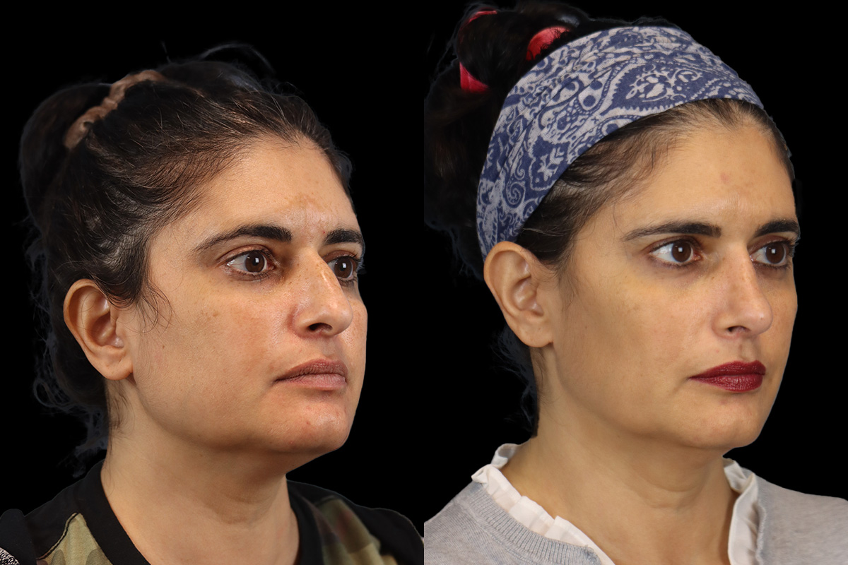 Nose Before and After | Leong Facial Plastic Surgery