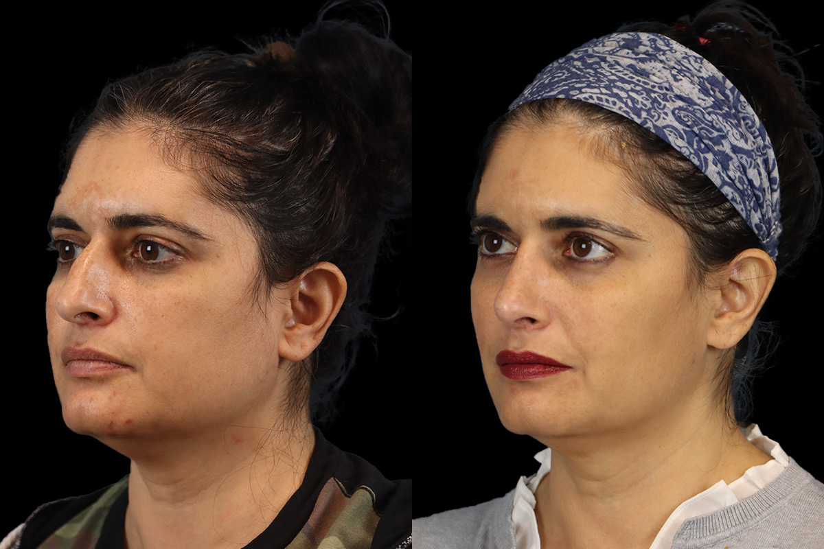 Nose Before and After | Leong Facial Plastic Surgery