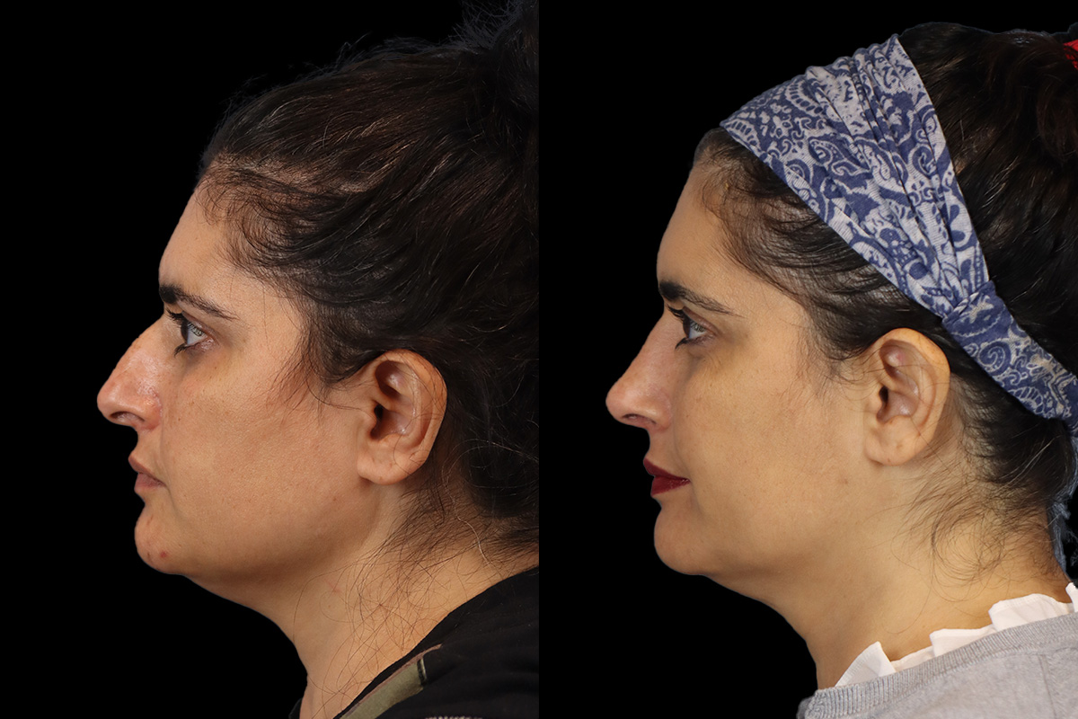 Nose Before and After | Leong Facial Plastic Surgery