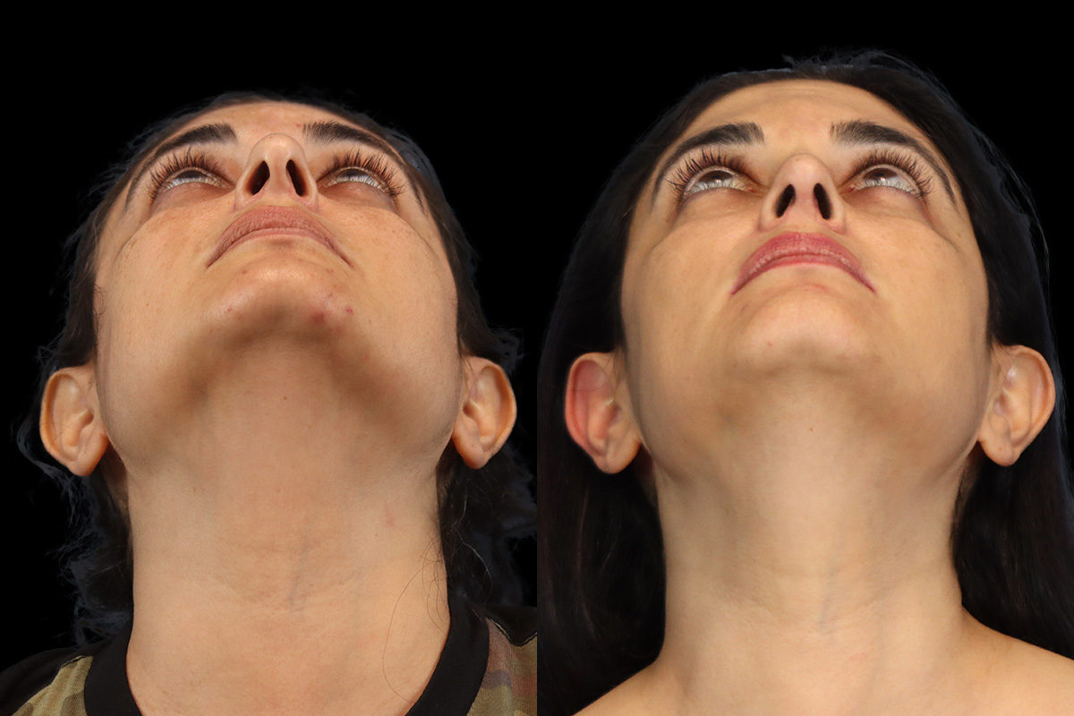 Nose Before and After | Leong Facial Plastic Surgery