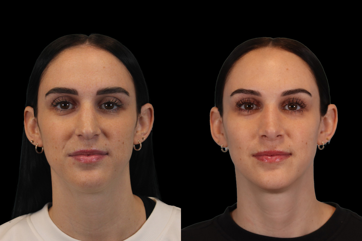 Nose Before and After | Leong Facial Plastic Surgery