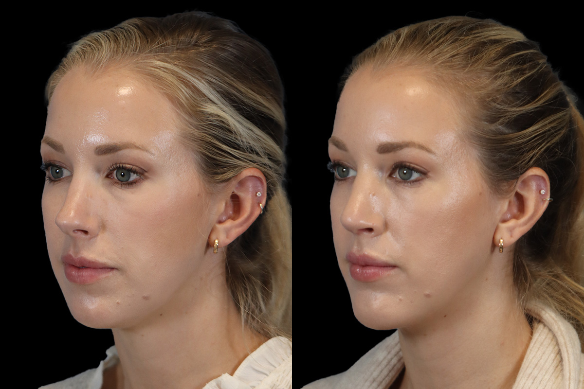 Nose Before and After | Leong Facial Plastic Surgery