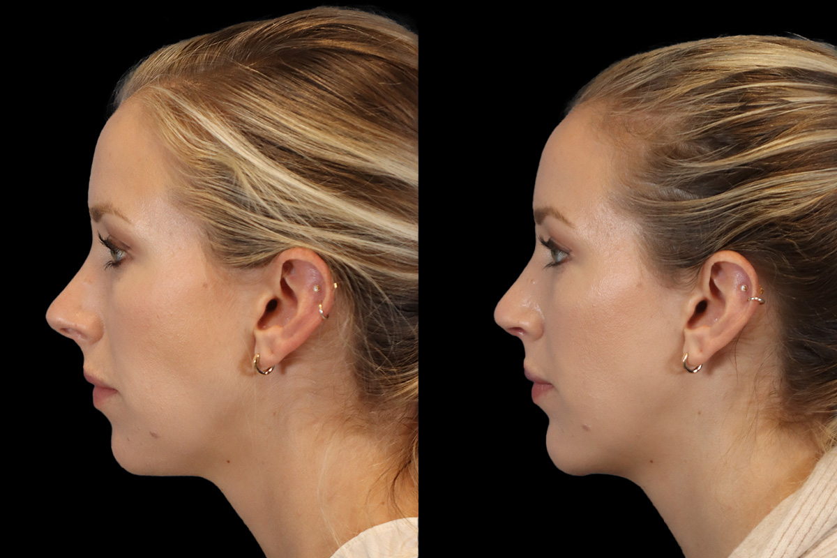 Nose Before and After | Leong Facial Plastic Surgery