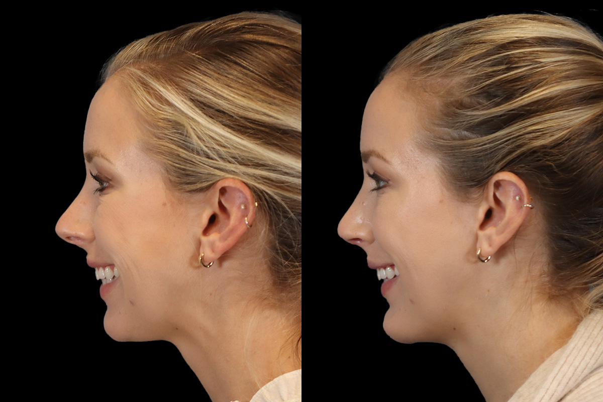 Nose Before and After | Leong Facial Plastic Surgery
