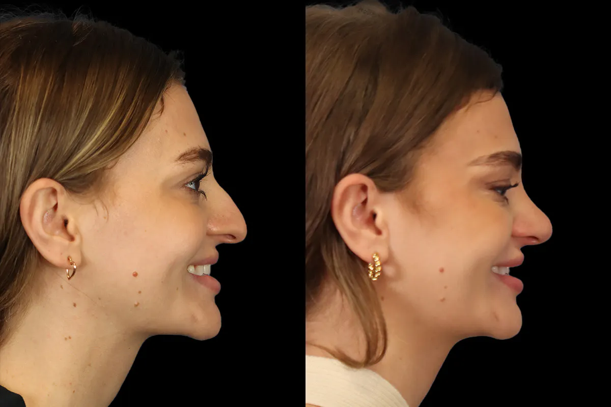 Nose Before and After | Leong Facial Plastic Surgery