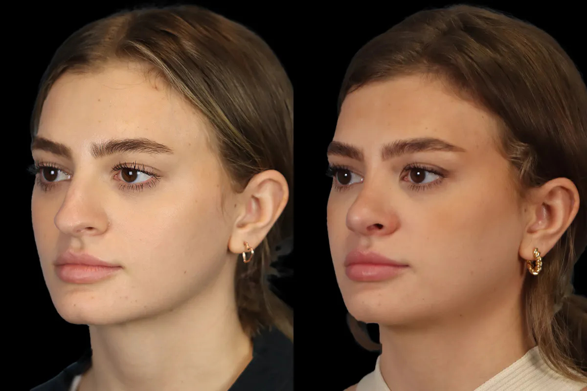 Nose Before and After | Leong Facial Plastic Surgery