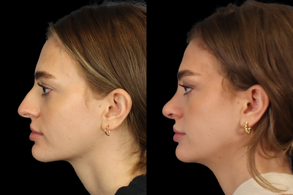 Nose Before and After | Leong Facial Plastic Surgery