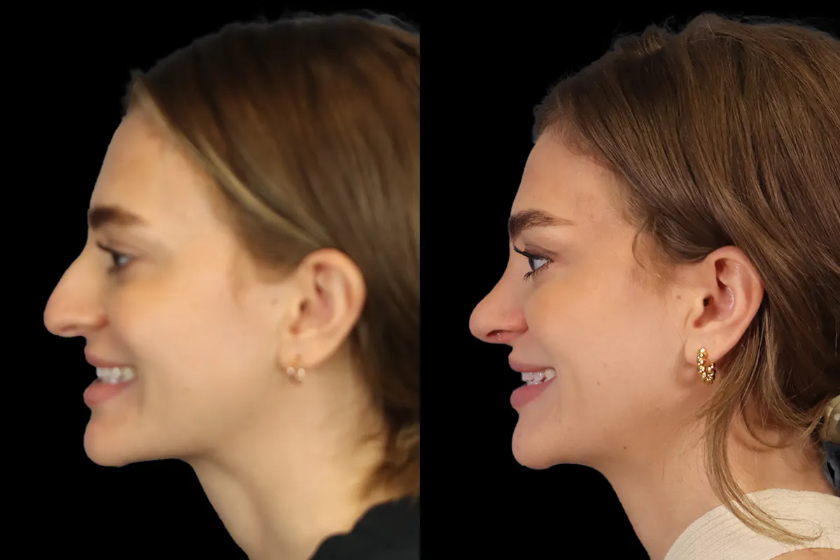 Nose Before and After | Leong Facial Plastic Surgery