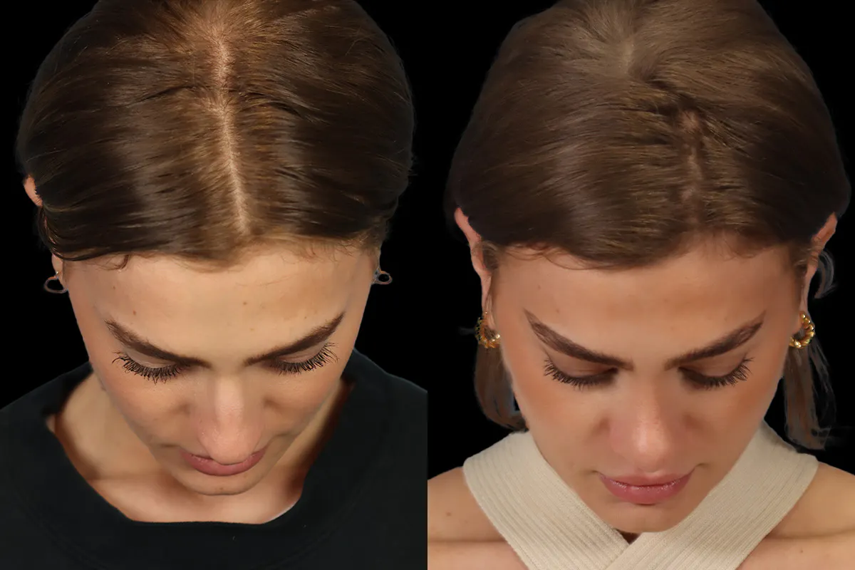 Nose Before and After | Leong Facial Plastic Surgery