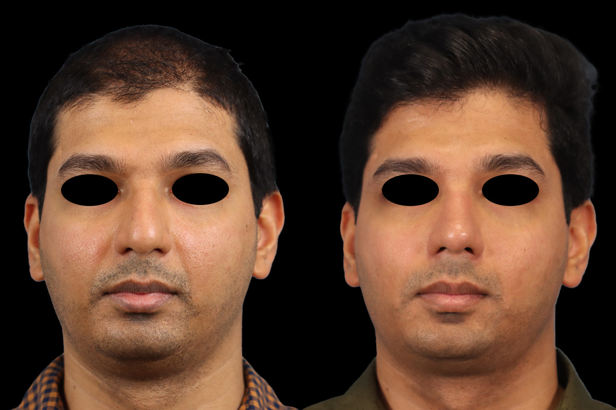 Nose Before and After | Leong Facial Plastic Surgery