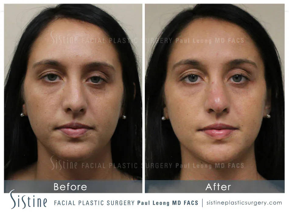 Nose Before and After | Leong Facial Plastic Surgery