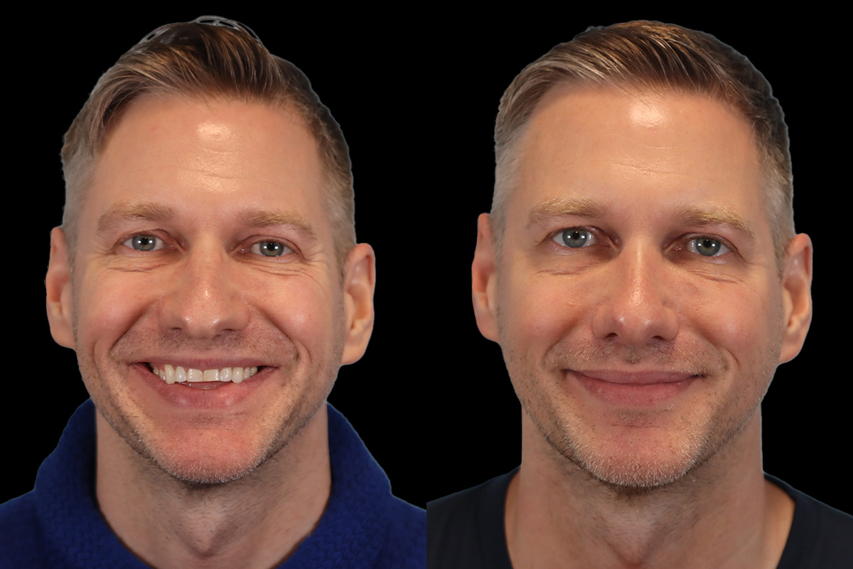 Nose Before and After | Leong Facial Plastic Surgery