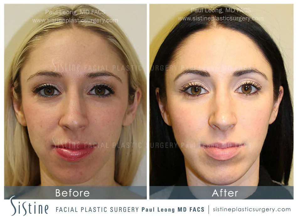 Nose Before and After | Leong Facial Plastic Surgery