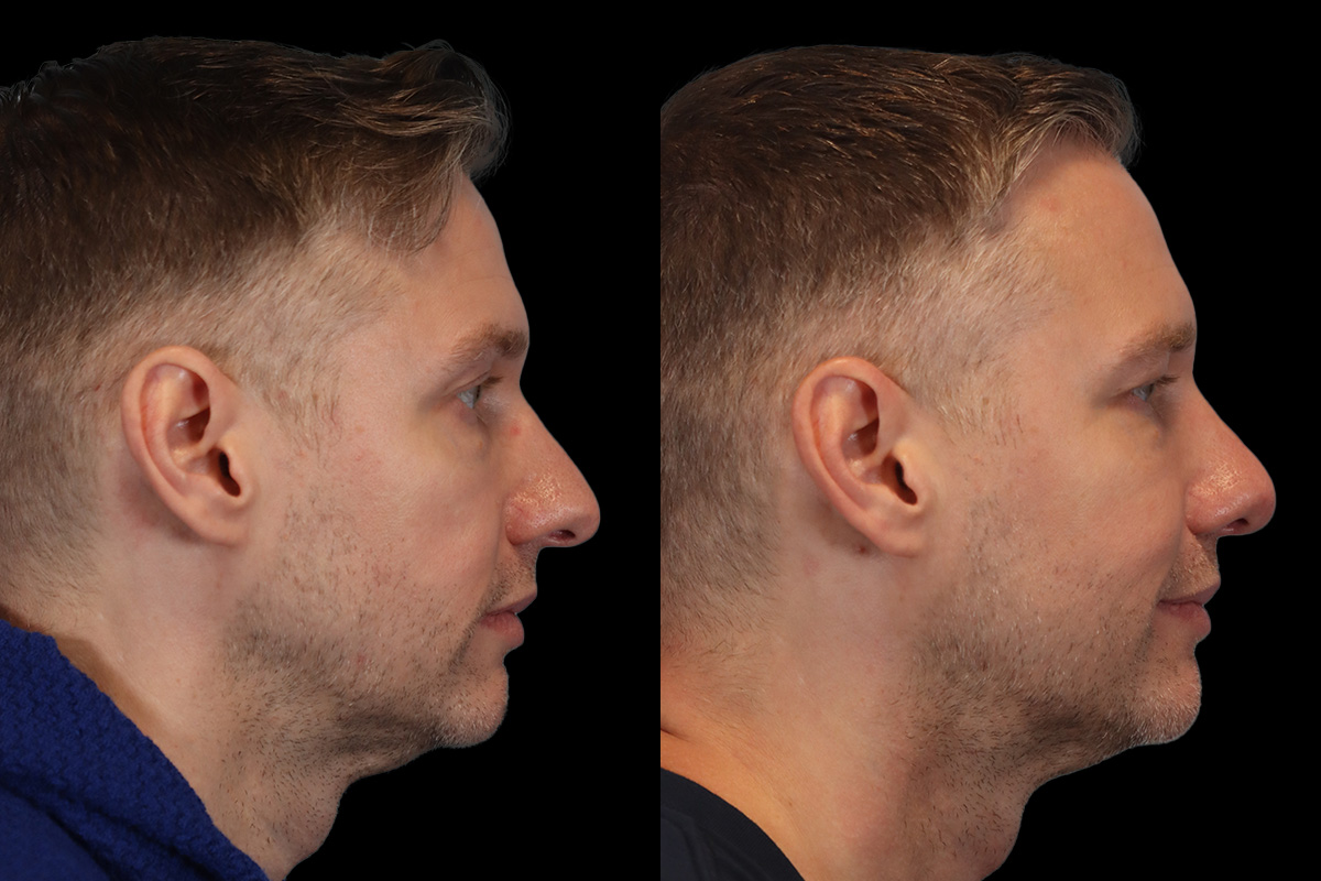 Nose Before and After | Leong Facial Plastic Surgery