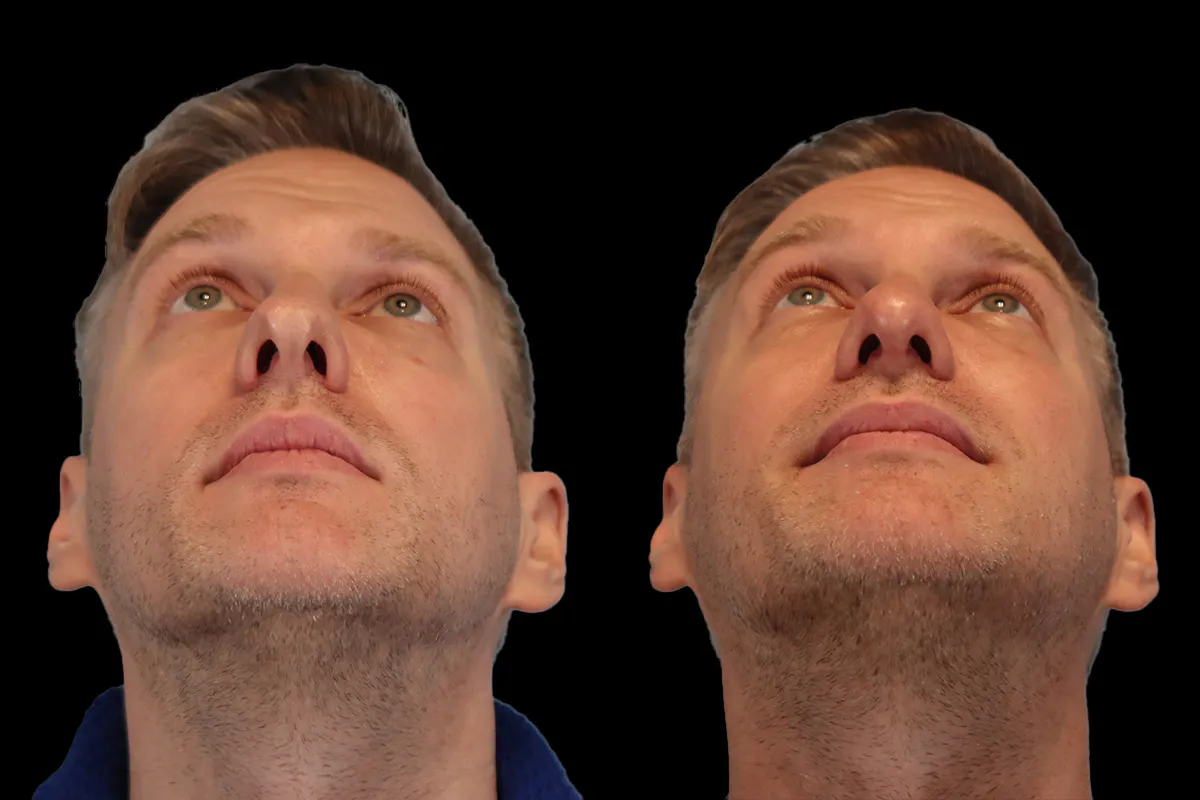 Nose Before and After | Leong Facial Plastic Surgery