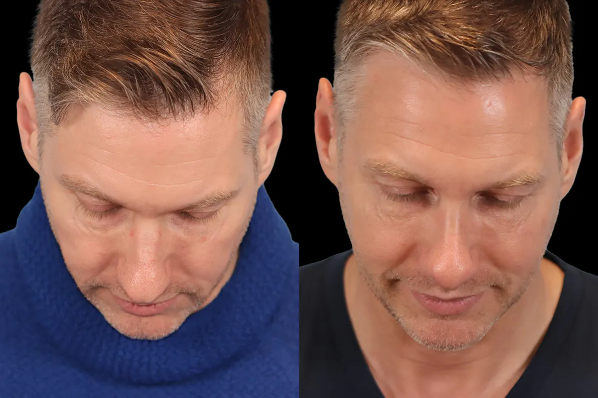 Nose Before and After | Leong Facial Plastic Surgery