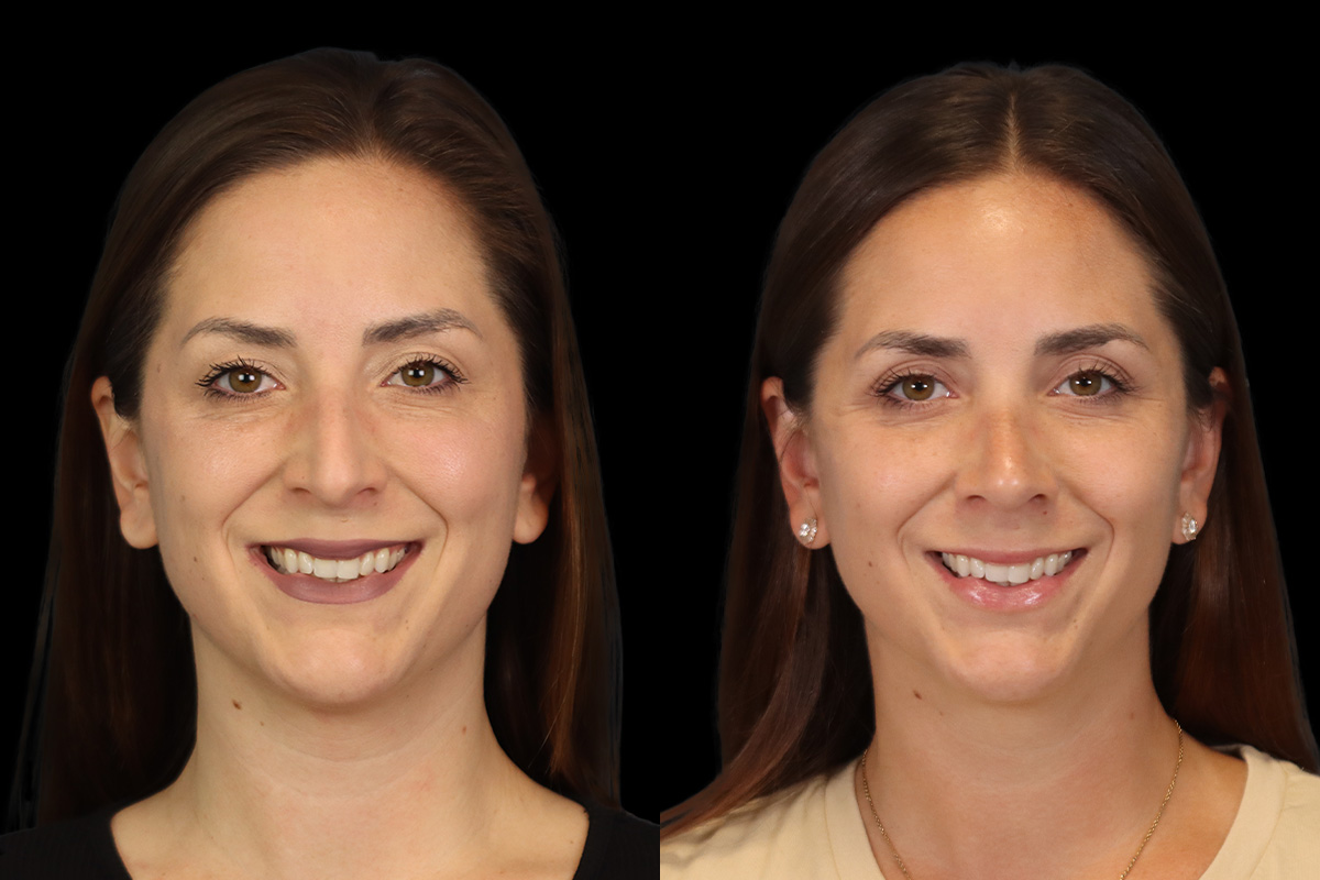 Nose Before and After | Leong Facial Plastic Surgery