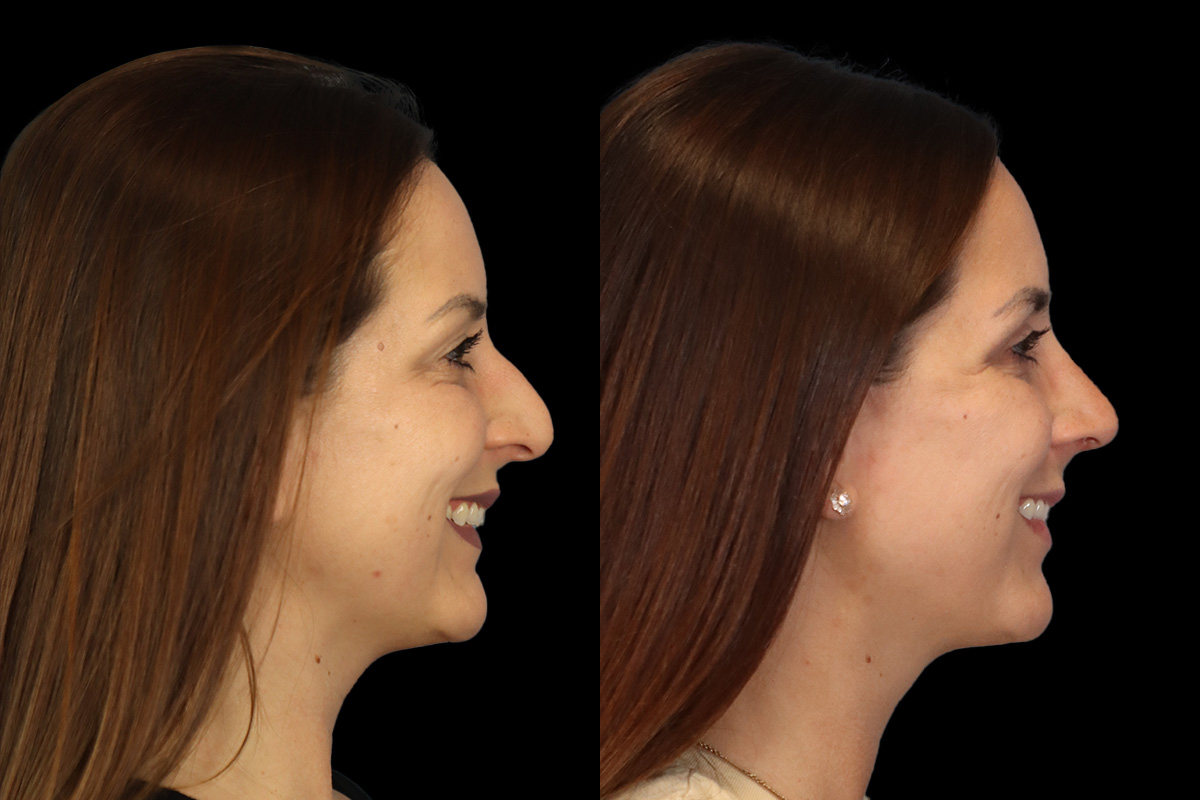 Nose Before and After | Leong Facial Plastic Surgery
