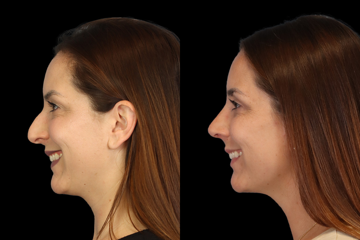 Nose Before and After | Leong Facial Plastic Surgery