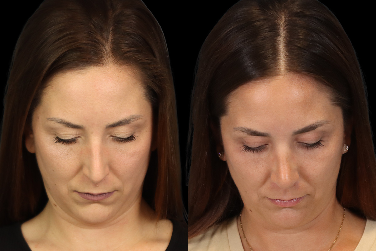 Nose Before and After | Leong Facial Plastic Surgery