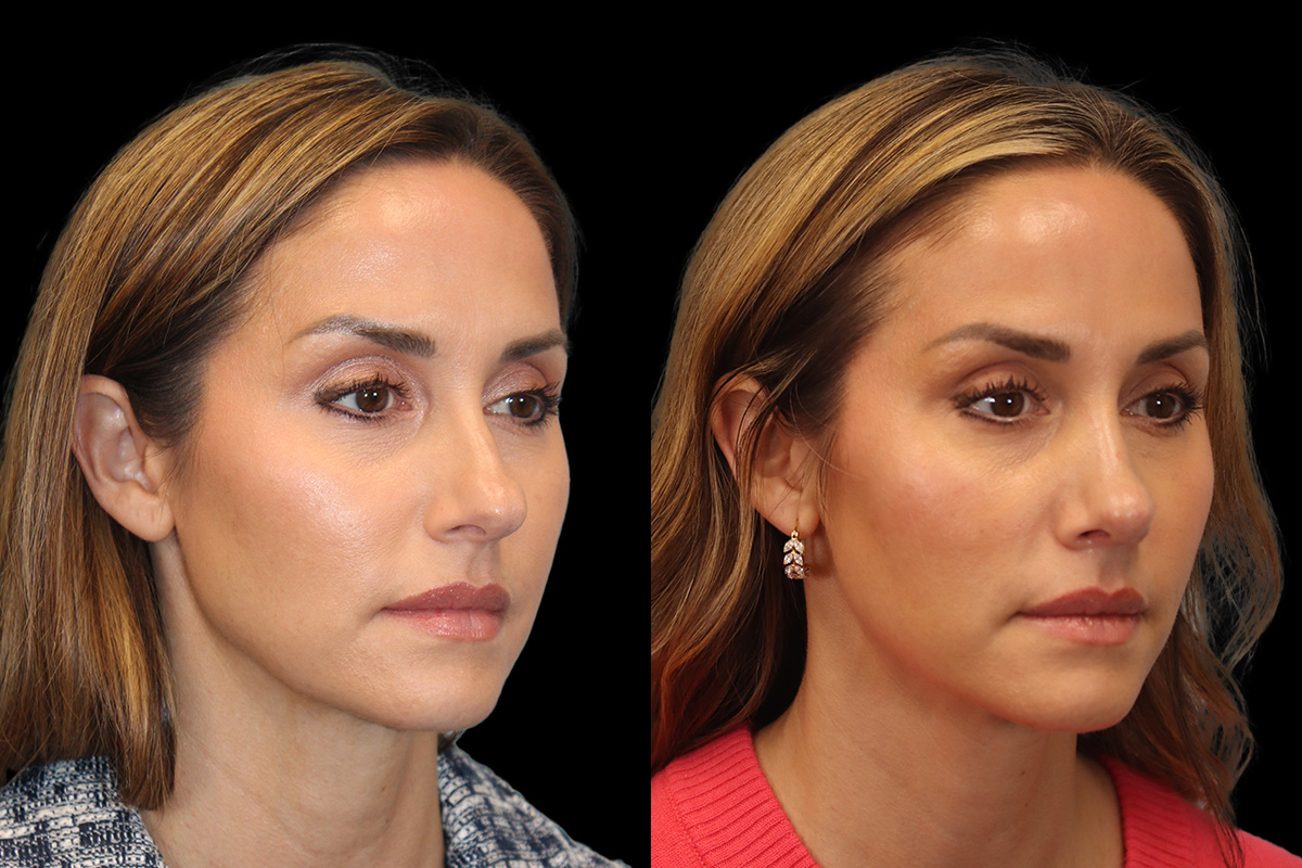 Nose Before and After | Leong Facial Plastic Surgery