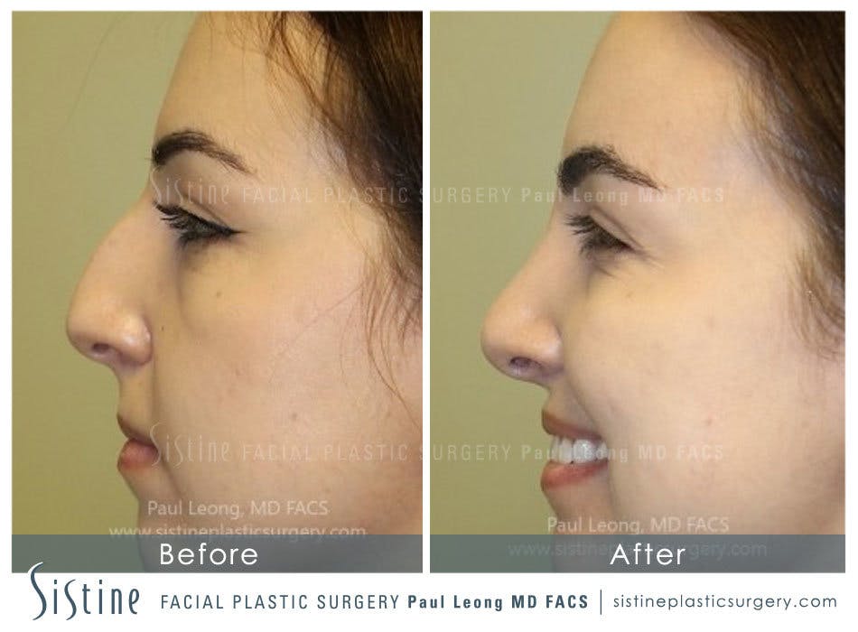 Nose Before and After | Leong Facial Plastic Surgery